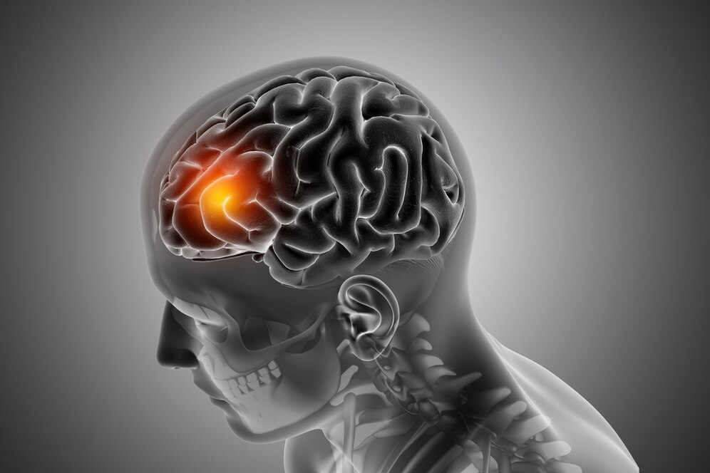Coágulo de sangre en el cerebro: cómo actuar
